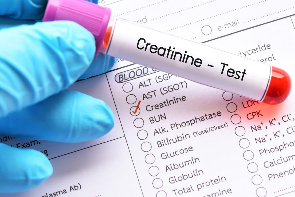 آزمايش كراتينين-Creatinine Test