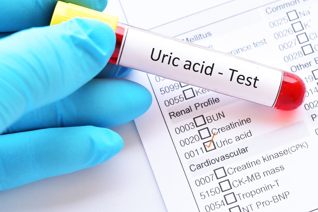 آزمايش اسيداوريك-Uric acid Test